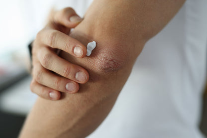 Cannasen Psoriasis Gel (50 ml)